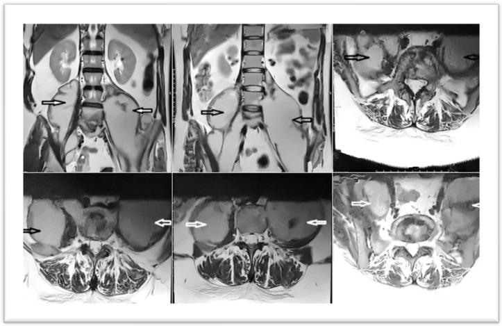 Giant Bilateral Iliopsoas Abscesses, Secondary to Pott's Disease: Challenging Diagnostic-Therapeutic Protocol Management (Modern and Innovative Open Approach Technique Through J.L. Petit Triangle)-A Case Report and Literature Review.