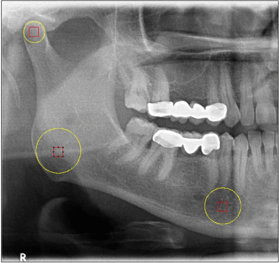 Evaluation of 3-year changes in panoramic radiomorphometric indices and fractal dimension values in primary hyperparathyroidism patients.