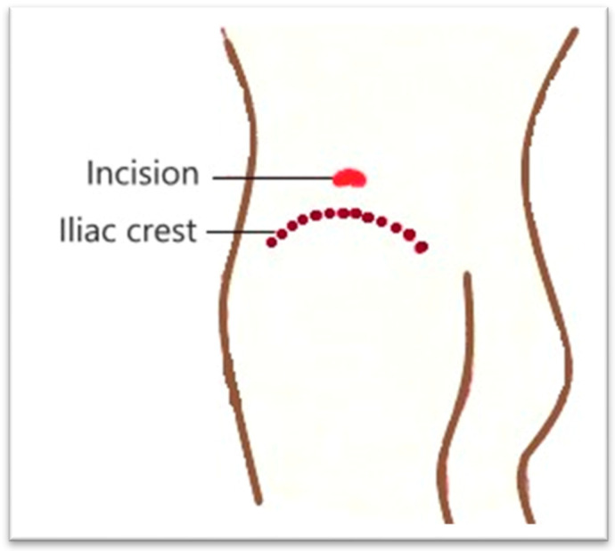 Giant Bilateral Iliopsoas Abscesses, Secondary to Pott's Disease: Challenging Diagnostic-Therapeutic Protocol Management (Modern and Innovative Open Approach Technique Through J.L. Petit Triangle)-A Case Report and Literature Review.