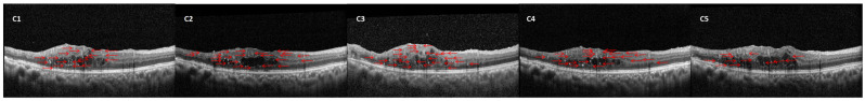 Hyperreflective Dots on SD-OCT: Implications for Predicting Treatment Outcomes in Diabetic Macular Edema.