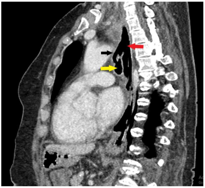 Endoscopic Repair of Tracheoesophageal Fistula with Vascular Embolization Plug.