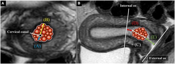 MRI localization evaluation to distinguish gastric-type adenocarcinoma and lobular endocervical glandular hyperplasia from other cystic lesions.