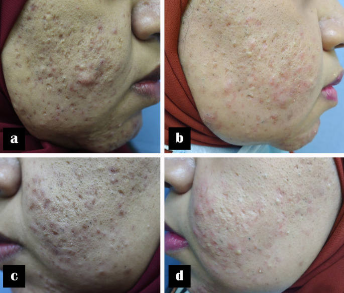 Comparative efficacy and safety of 577-nm diode laser versus 1064-nm Nd: YAG laser for inflammatory acne vulgaris: a split-face randomized study.