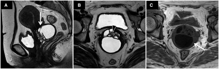 MRI localization evaluation to distinguish gastric-type adenocarcinoma and lobular endocervical glandular hyperplasia from other cystic lesions.