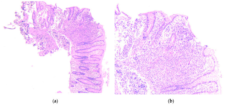 Synchronous Pulmonary and Cecal High-Grade Neuroendocrine Carcinomas Presenting as Hepatic Metastases: A Diagnostic Challenges and Literature Review.
