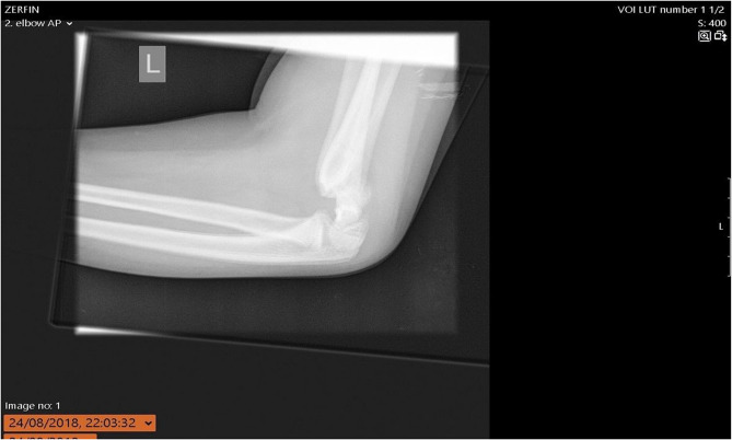 Electric scooter related injuries among children: a single institutional experience.