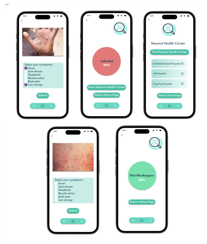 Deep Learning-Based Mpox Skin Lesion Detection and Real-Time Monitoring in a Smart Healthcare System.