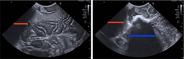 Identifying visible tissue in intraoperative ultrasound: a method and application.