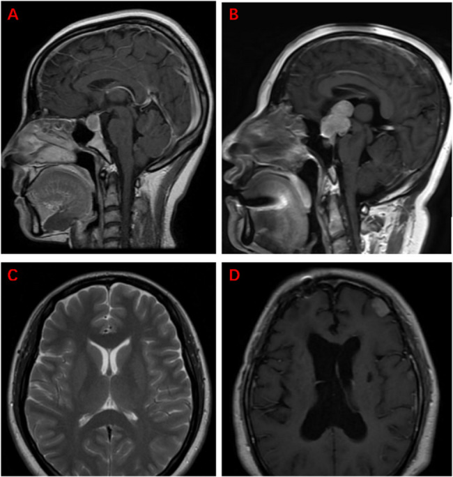 Classification of and risk factors for sodium imbalance developing after transsphenoidal surgery for pituitary neuroendocrine tumors.