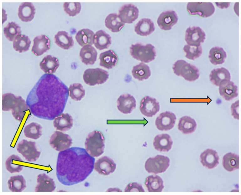 An Account of Acute Myeloid Leukemia Complicating Pregnancy and Literature Review.