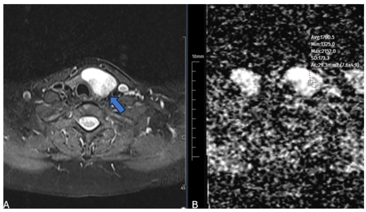 Apparent Diffusion Coefficient as a Predictor of Microwave Ablation Response in Thyroid Nodules: A Prospective Study.