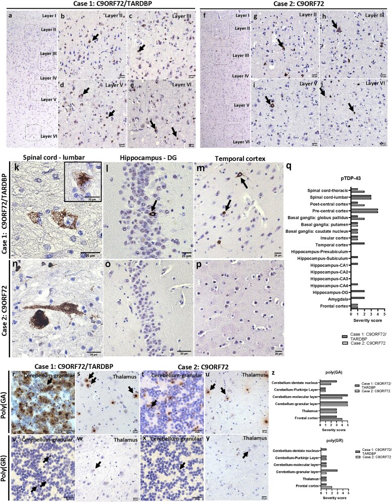 Tracing neuropathological signatures: TARDBP and C9orf72 double mutations in a Sicilian family.