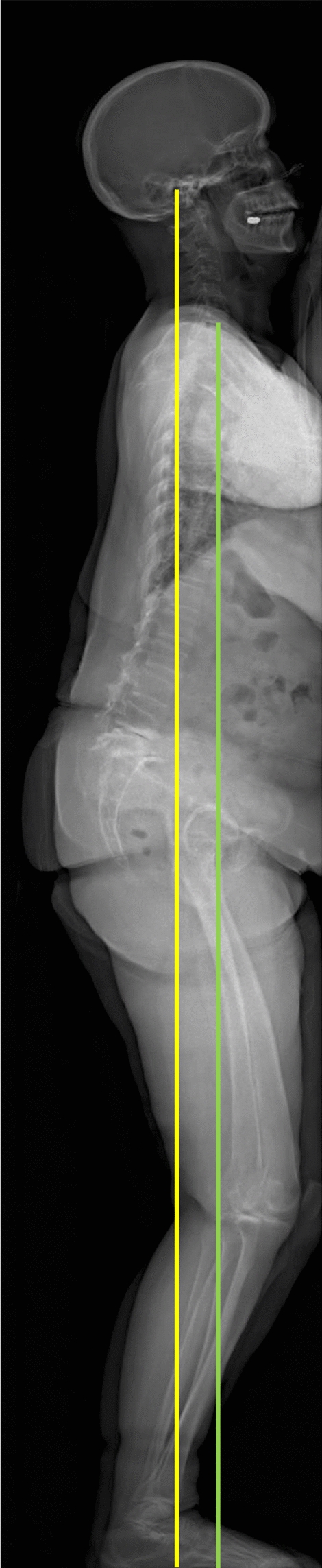 Predictors of flexion contracture progression following total knee arthroplasty: role of global sagittal alignment and patient age.
