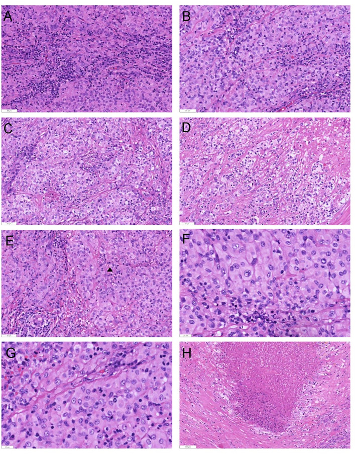 Clinicopathological characteristics and molecular genetic analysis of inflammatory and nested testicular sex cord tumor: a case report and literature review.