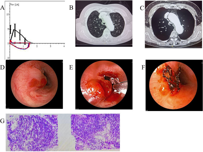 Severe central airway obstruction caused by primary endobronchial B-cell lymphoma: three case reports and literature review.