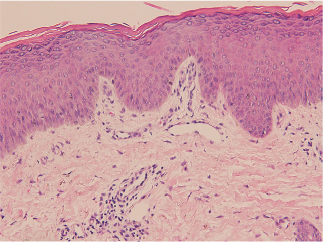 A Seven-year-old Girl with Exfoliative Erythroderma: A Quiz.