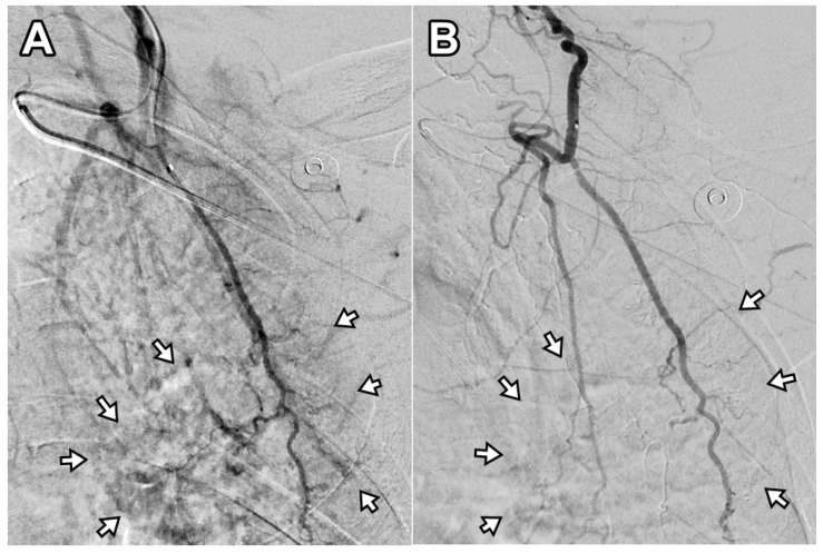 Transarterial Embolization for Refractory Non-Cervical-Origin Interscapular Pain Following Ultrasound-Guided Injection: A Retrospective Feasibility Study.