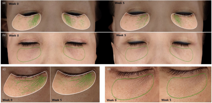 Nonsurgical lower eyelid rejuvenation using a novel 1064-nm Nd:YAG laser with a 650- microsecond pulse duration.