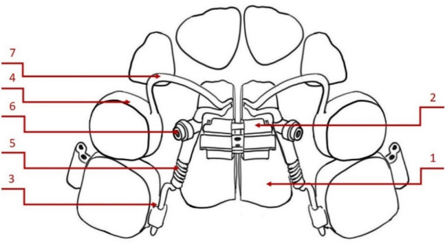 Optimizing orthodontic treatment for delayed eruption of permanent anterior teeth: A prospective study using a modified appliance.