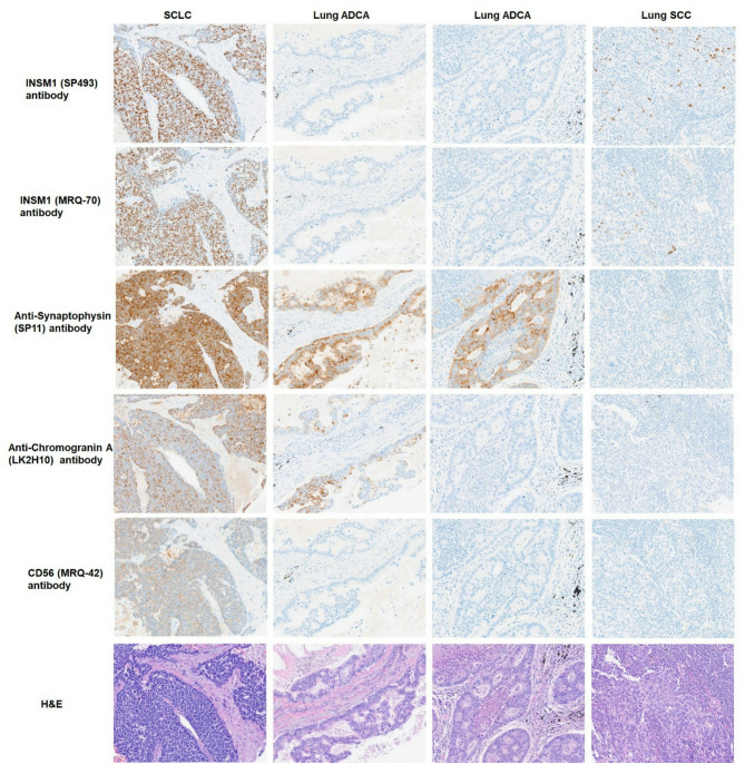 Novel immunohistochemical assay utilizing the INSM1 (SP493) antibody demonstrates high specificity and sensitivity in detecting primary neuroendocrine lung neoplasms.
