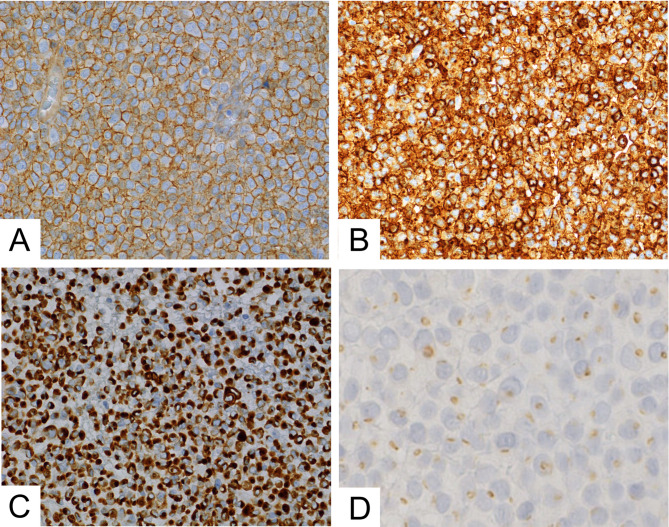 EWSR1::BEND2 fusion sarcoma of the urinary bladder - a case report and review of literature.