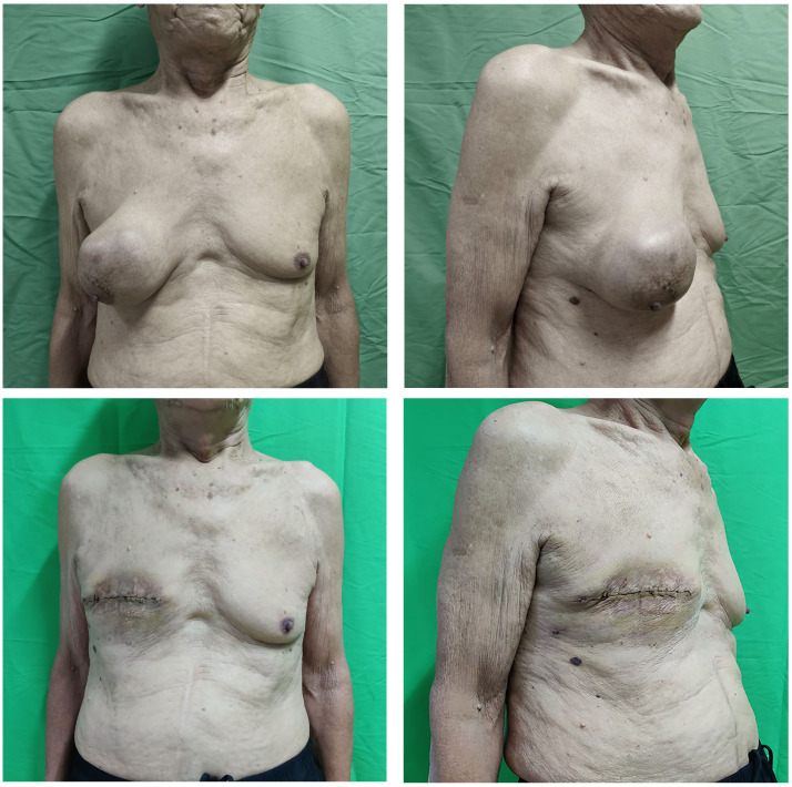 Case Report: Primary breast leiomyosarcoma in an 84-year-old male.