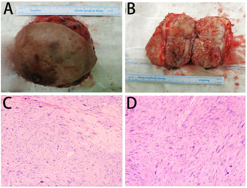 Case Report: Primary breast leiomyosarcoma in an 84-year-old male.