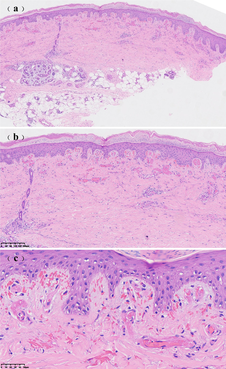 Successful Treatment of Refractory Livedoid Vasculopathy with Upadacitinib: A Case Report.
