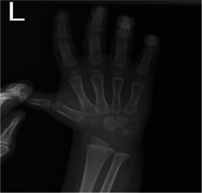 Challenge faced in diagnosis and treatment of congenital hypothyroidism presenting with isosexual puberty and bilateral ovarian mass in low and middle income country: a case report.