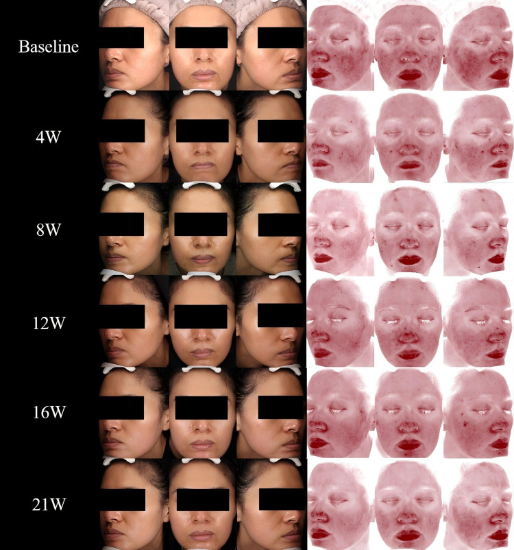 HaiTang Heji Formula for Moderate Rosacea Refractory to Conventional Therapies: A Case Report Demonstrating Holistic Improvement in Physical and Psychological Symptoms.