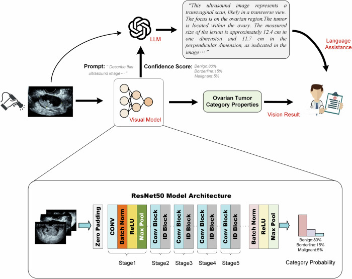 Ultrasound-based deep learning model as an assistant improves the diagnosis of ovarian tumors: a multicenter study.