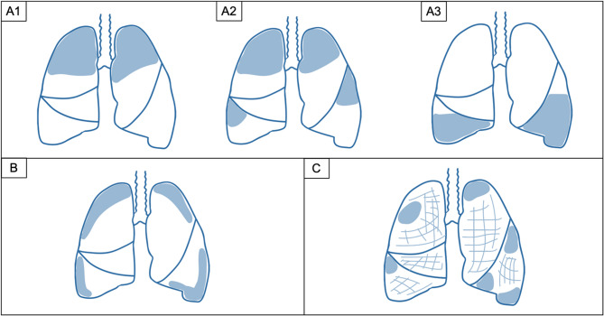 Surgical lung volume reduction eligibility in an emphysema patient pool referred for endoscopic treatment.
