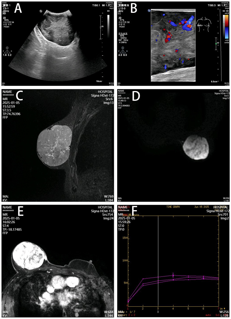 Case Report: Primary breast leiomyosarcoma in an 84-year-old male.
