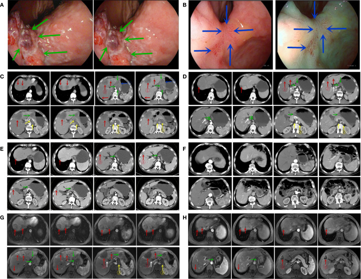 Pathologic complete response of advanced hepatoid adenocarcinoma of the stomach following immuno-chemotherapy and conversion surgery: a rare case report and review of the literature.