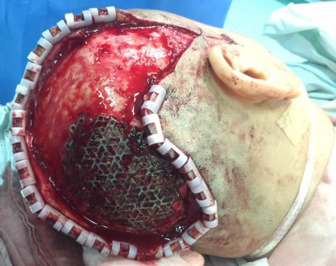 Hair Transplantation on Free Flap in a Patient with Malignant Scalp Neoplasms: A Case Report.