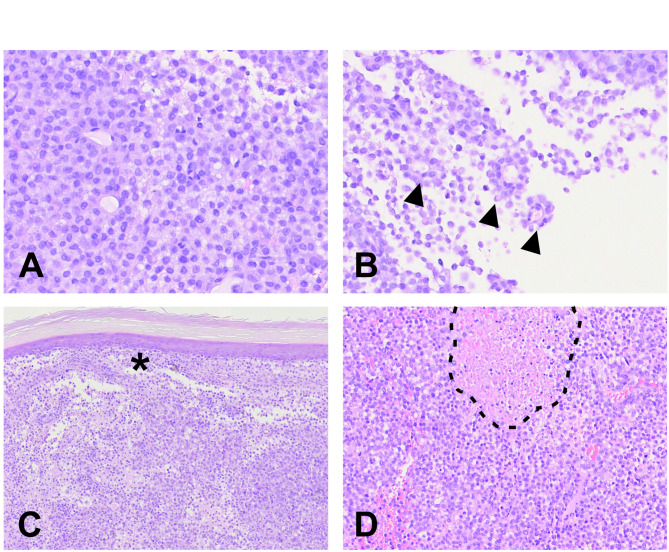 EWSR1::BEND2 fusion sarcoma of the urinary bladder - a case report and review of literature.