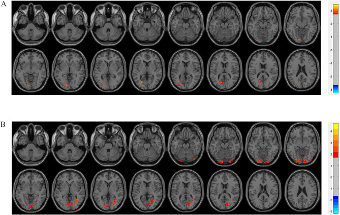 Multimodal Brain Monitoring-Guided Anesthesia Management Improves Functional Connectivity, Enhances Recovery and Attenuates Postoperative Pain in Elderly Surgical Patients.