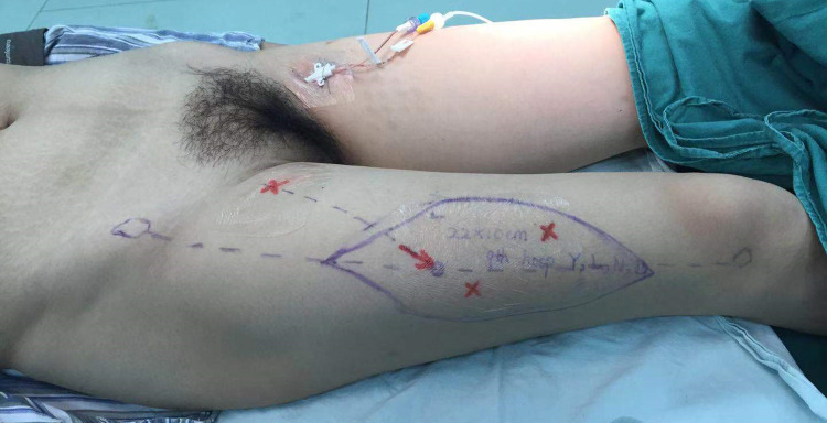 Hair Transplantation on Free Flap in a Patient with Malignant Scalp Neoplasms: A Case Report.