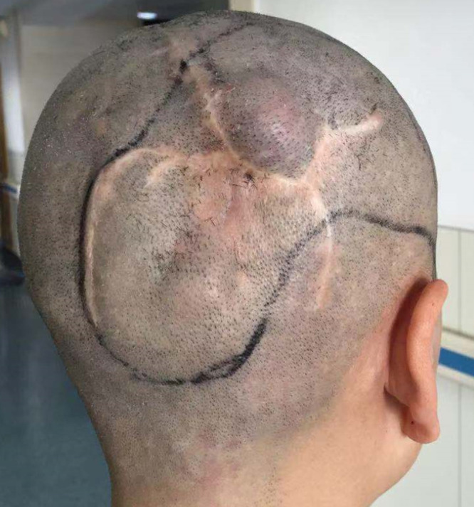Hair Transplantation on Free Flap in a Patient with Malignant Scalp Neoplasms: A Case Report.