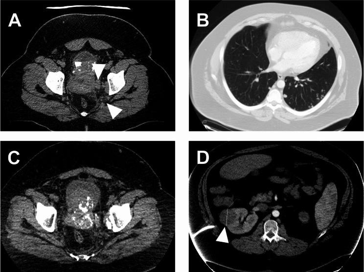 EWSR1::BEND2 fusion sarcoma of the urinary bladder - a case report and review of literature.