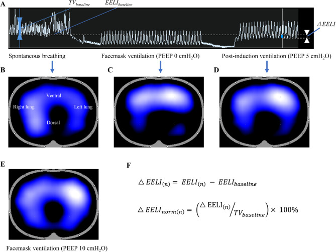 Applying positive end-expiratory pressure to facemask ventilation improves post-induction lung atelectasis: a three-arm randomized controlled trial.