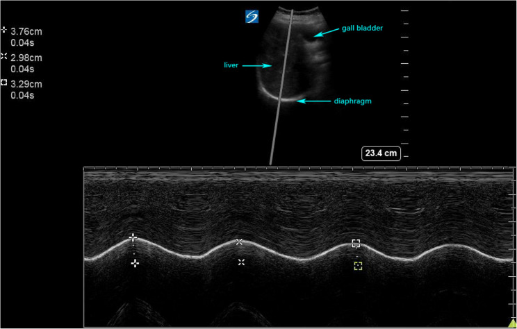 Effect of liposomal bupivacaine for the suprascapular nerve combined with axillary nerve block on postoperative analgesia in patients undergoing shoulder surgery: a randomized, observer-blinded trial.