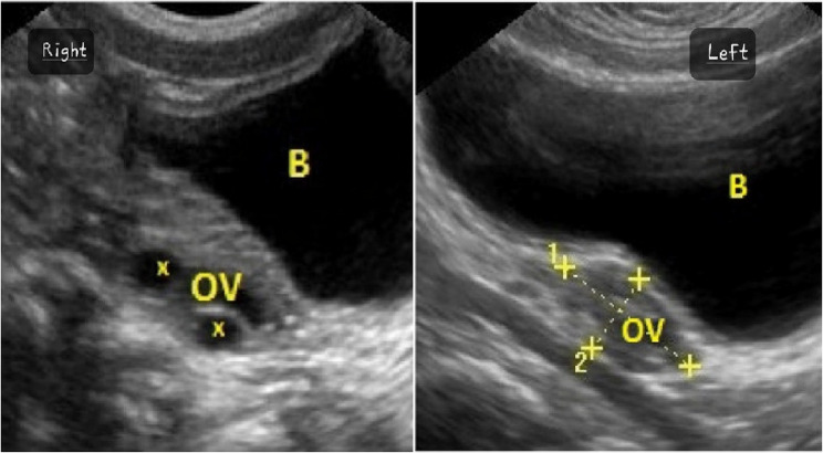Challenge faced in diagnosis and treatment of congenital hypothyroidism presenting with isosexual puberty and bilateral ovarian mass in low and middle income country: a case report.