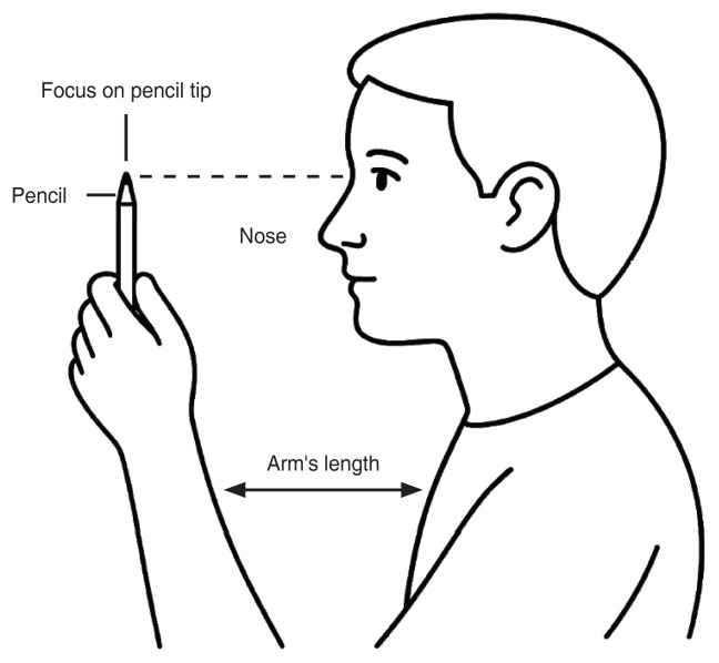 Effectiveness of Pencil Push-up Exercises in Patients with Convergence Insufficiency-Type Exotropia with Receded Near Point of Convergence: A Retrospective Observational Study.