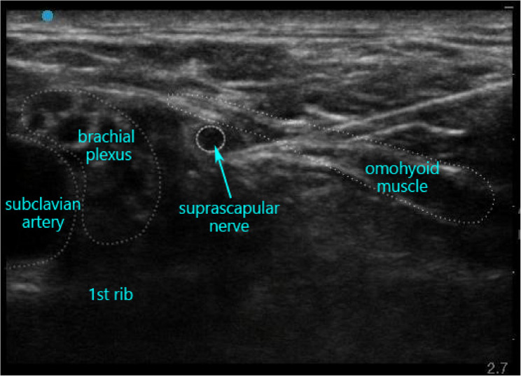 Effect of liposomal bupivacaine for the suprascapular nerve combined with axillary nerve block on postoperative analgesia in patients undergoing shoulder surgery: a randomized, observer-blinded trial.