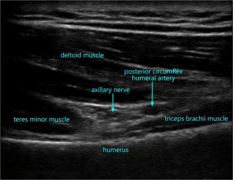 Effect of liposomal bupivacaine for the suprascapular nerve combined with axillary nerve block on postoperative analgesia in patients undergoing shoulder surgery: a randomized, observer-blinded trial.