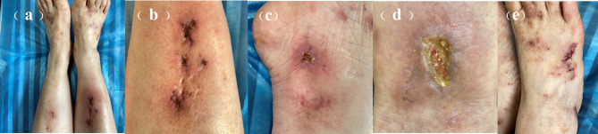 Successful Treatment of Refractory Livedoid Vasculopathy with Upadacitinib: A Case Report.