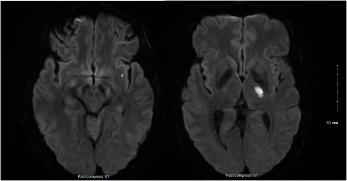 Case Report: Mevalonate kinase deficiency: an underdiagnosed cause of ischemic stroke-characterization of a novel genetic variant.