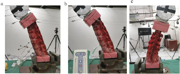 L5 spondylolysis increases segmental mobility at the cranial adjacent level without altering intervertebral disc contact pressure.