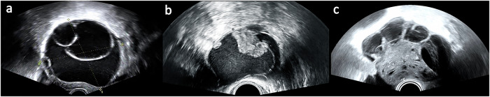 Ultrasound-based deep learning model as an assistant improves the diagnosis of ovarian tumors: a multicenter study.